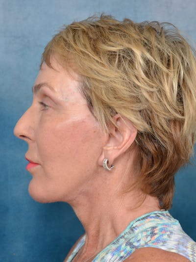 Brow Lift Before & After Gallery - Patient 133259415 - Image 6