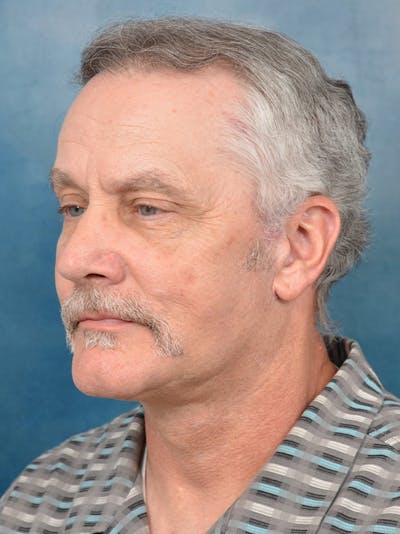 Brow Lift Before & After Gallery - Patient 133338025 - Image 4