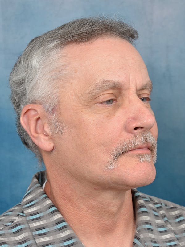 Brow Lift Before & After Gallery - Patient 133338025 - Image 8