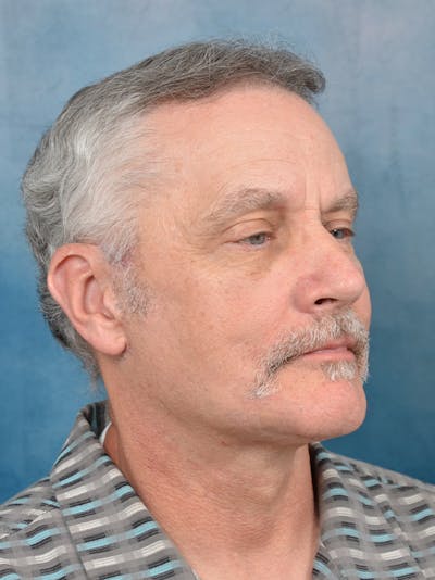 Deep Plane Facelift Before & After Gallery - Patient 133337061 - Image 8