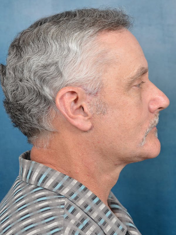Deep Plane Facelift Before & After Gallery - Patient 133337061 - Image 10