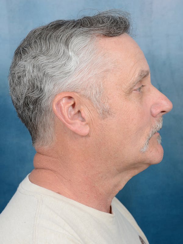Deep Plane Facelift Before & After Gallery - Patient 133337061 - Image 9