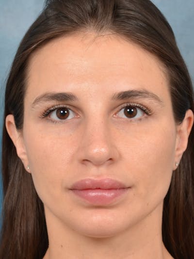 Rhinoplasty Before & After Gallery - Patient 133172714 - Image 6