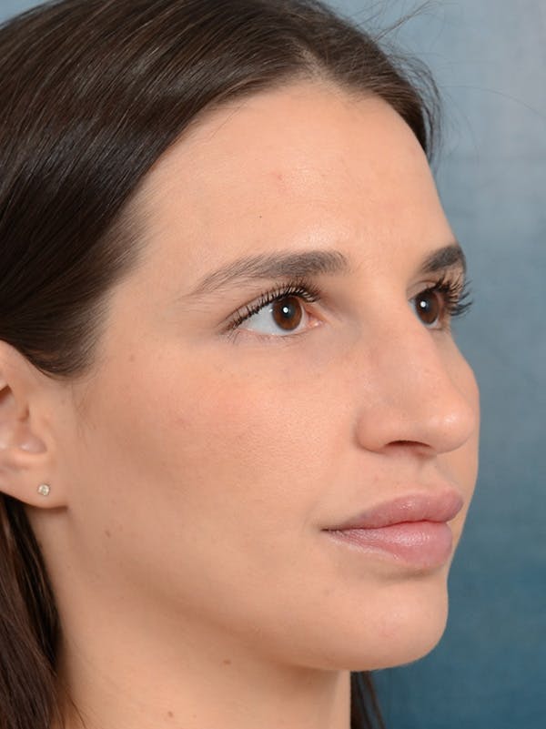 Rhinoplasty Before & After Gallery - Patient 133172714 - Image 7