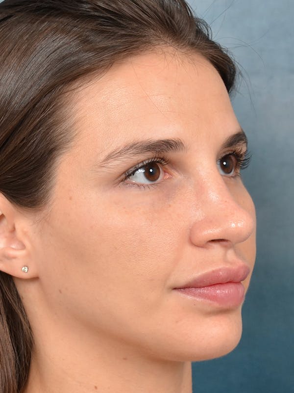 Rhinoplasty Before & After Gallery - Patient 133172714 - Image 8