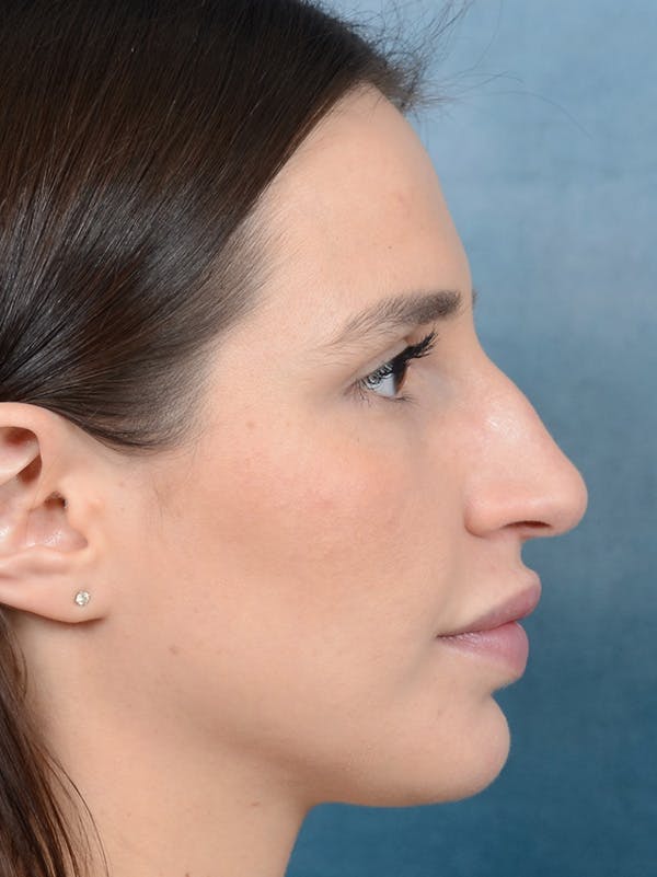 Rhinoplasty Before & After Gallery - Patient 133172714 - Image 9