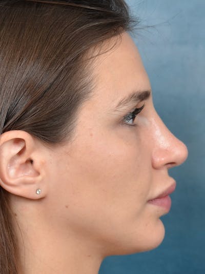 Rhinoplasty Before & After Gallery - Patient 133172714 - Image 10