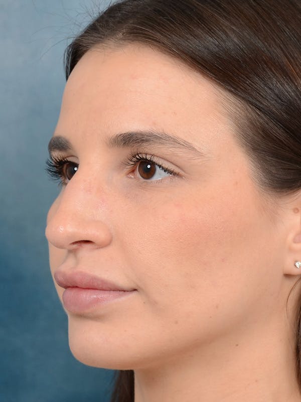 Rhinoplasty Before & After Gallery - Patient 133172714 - Image 3