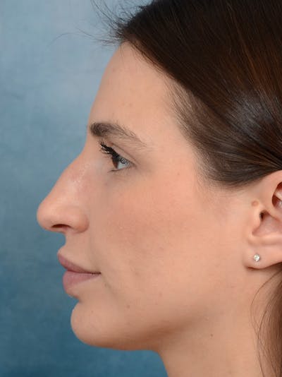 Rhinoplasty Before & After Gallery - Patient 133172714 - Image 1