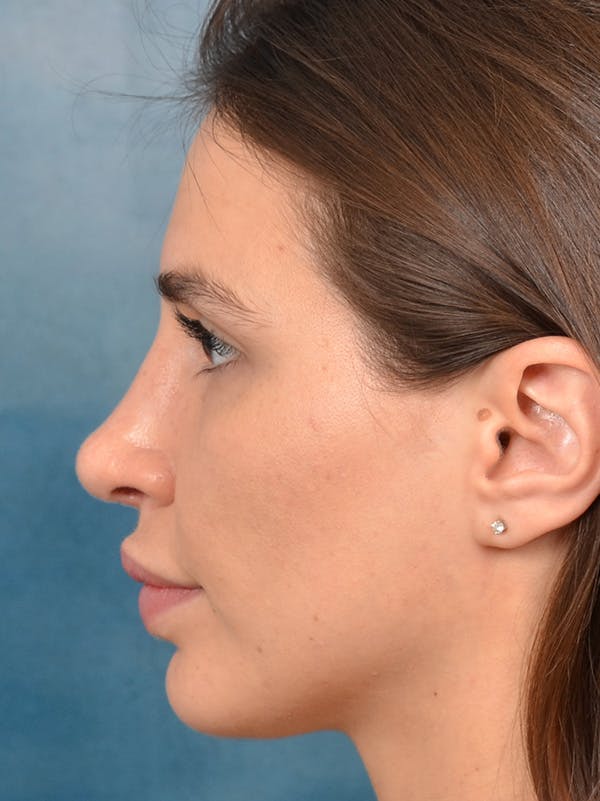 Rhinoplasty Before & After Gallery - Patient 133172714 - Image 2