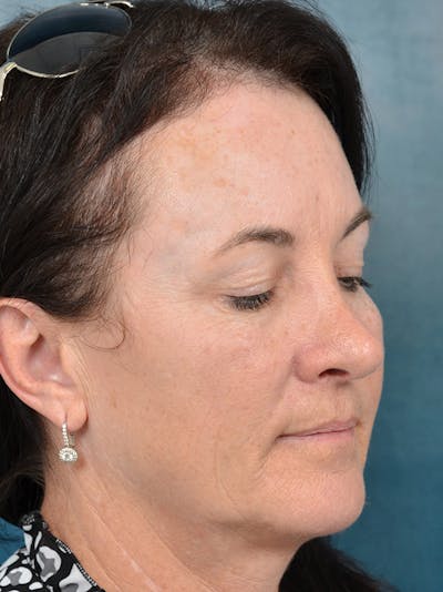 Brow Lift Before & After Gallery - Patient 141068018 - Image 8
