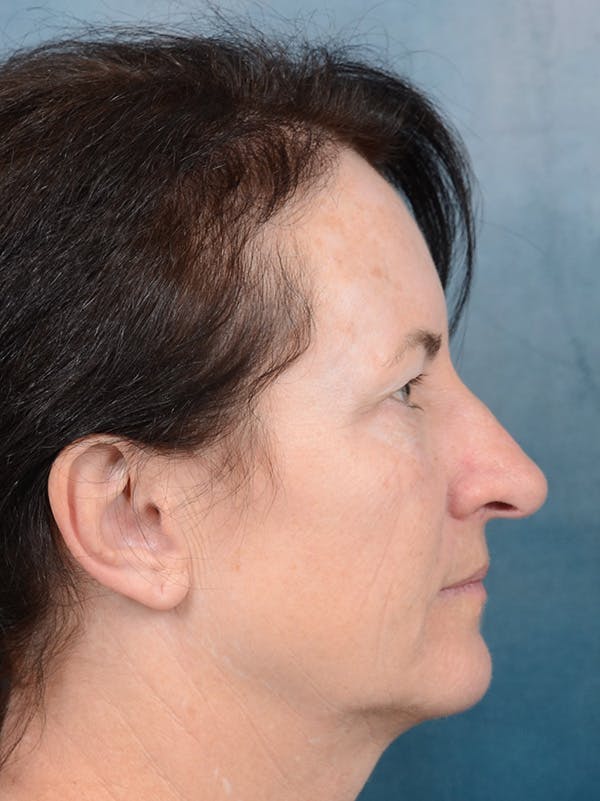 Rhinoplasty Before & After Gallery - Patient 140821302 - Image 9