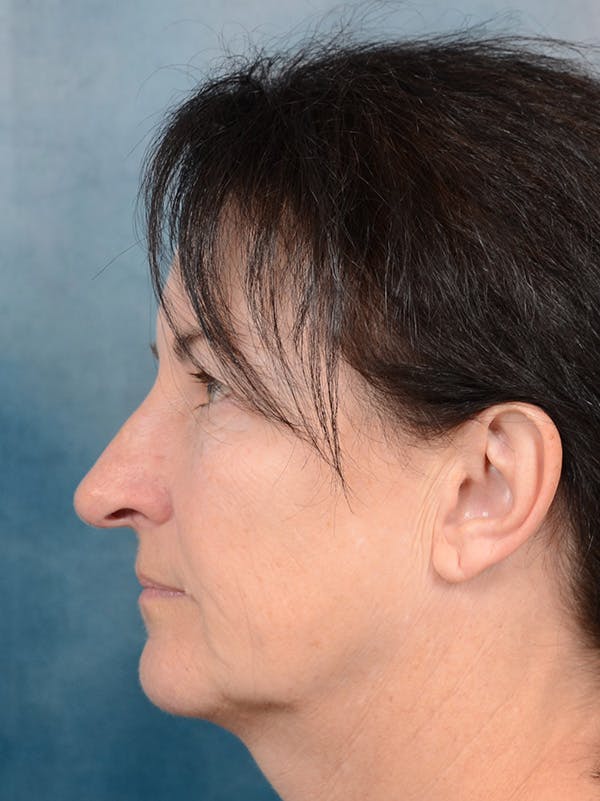Rhinoplasty Before & After Gallery - Patient 140821302 - Image 1