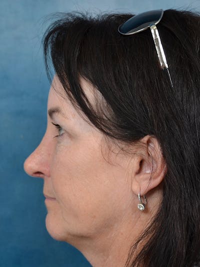 Brow Lift Before & After Gallery - Patient 141068018 - Image 4