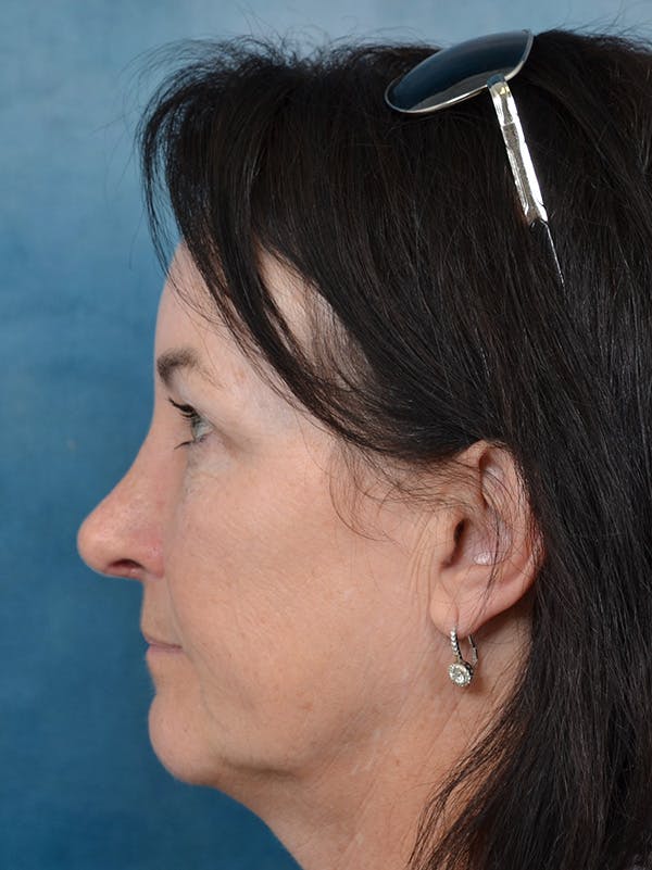 Brow Lift Before & After Gallery - Patient 141068018 - Image 4