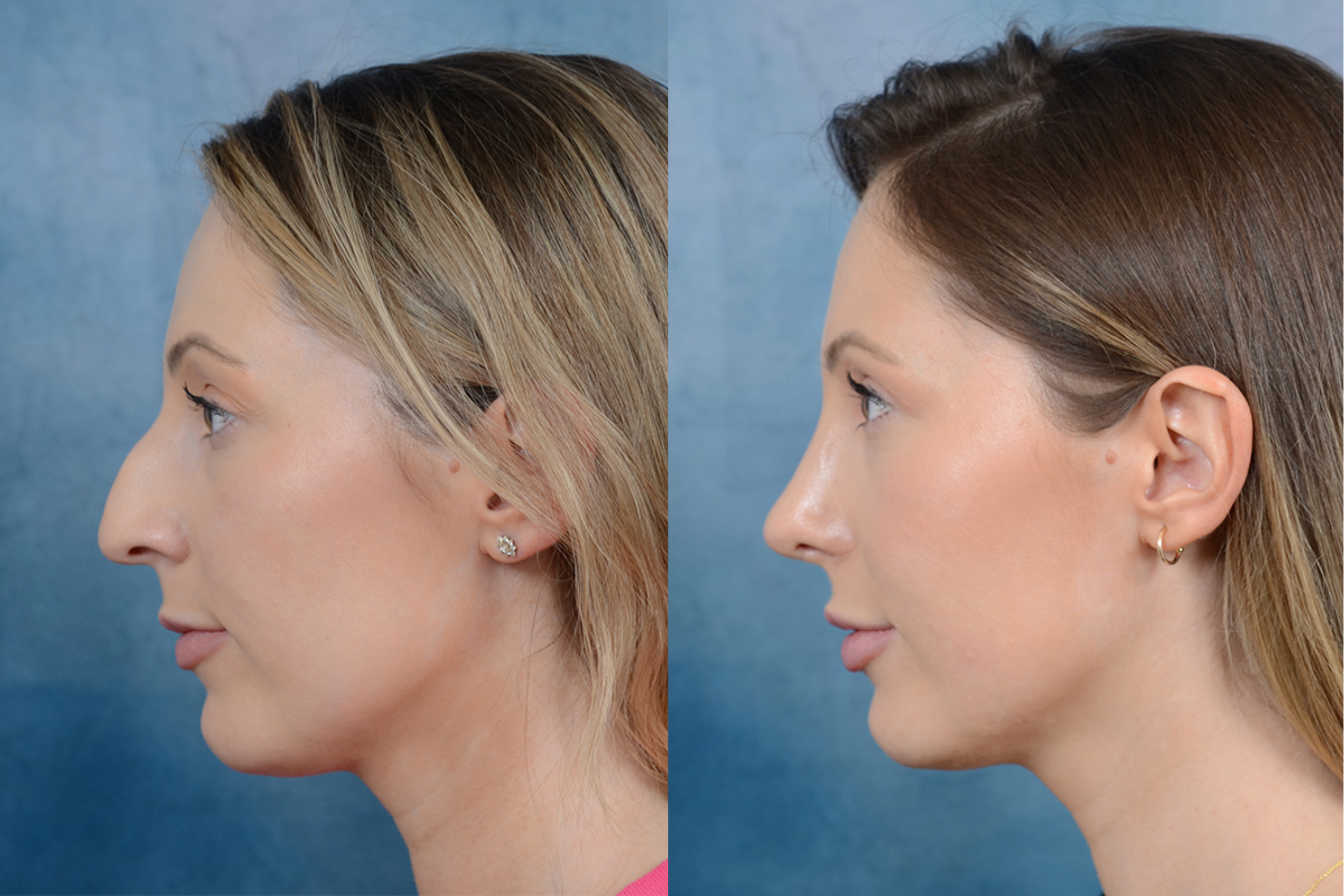 Rhinoplasty in 2025: What’s the Real Cost?