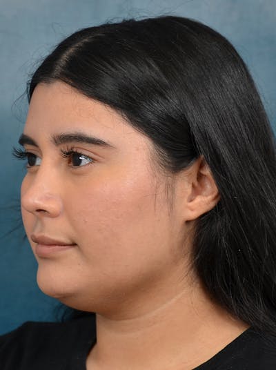 Rhinoplasty Before & After Gallery - Patient 140840468 - Image 10