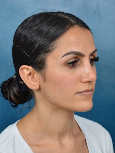 Rhinoplasty Before & After Gallery - Patient 141137449 - Image 8