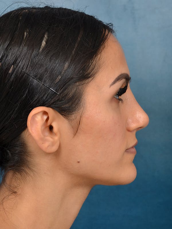 Rhinoplasty Before & After Gallery - Patient 141137449 - Image 10