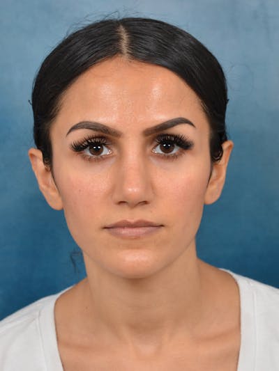 Rhinoplasty Before & After Gallery - Patient 141137449 - Image 4