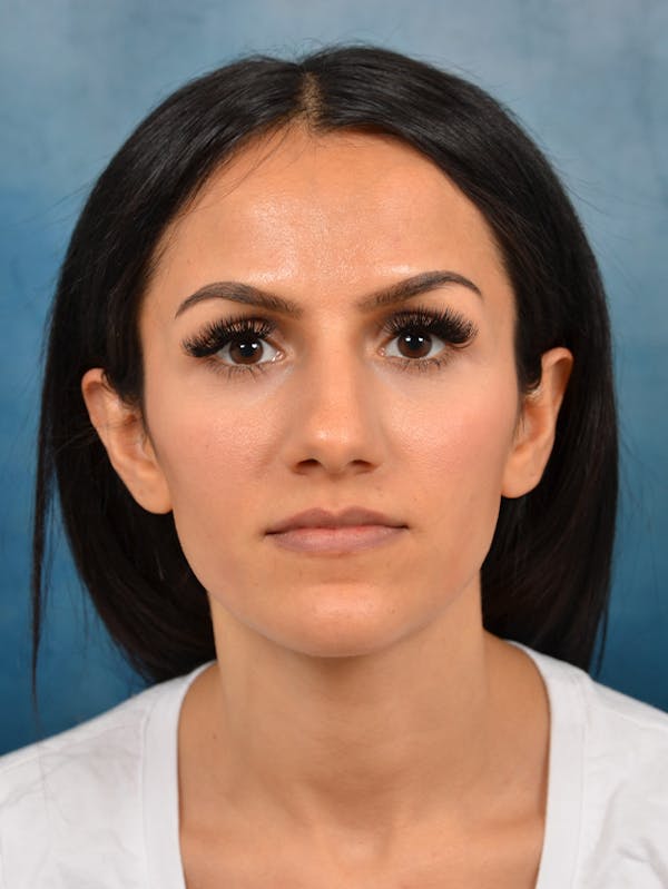 Rhinoplasty Before & After Gallery - Patient 141137449 - Image 3