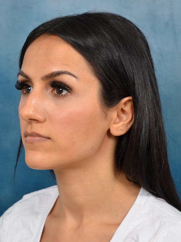 Rhinoplasty Before & After Gallery - Patient 141137449 - Image 5