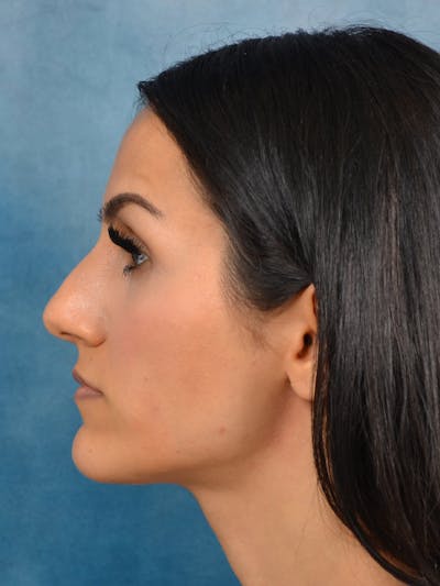 Rhinoplasty Before & After Gallery - Patient 141137449 - Image 1