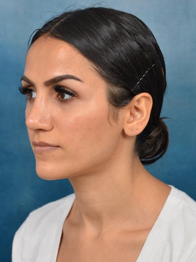 Rhinoplasty Before & After Gallery - Patient 141137449 - Image 6