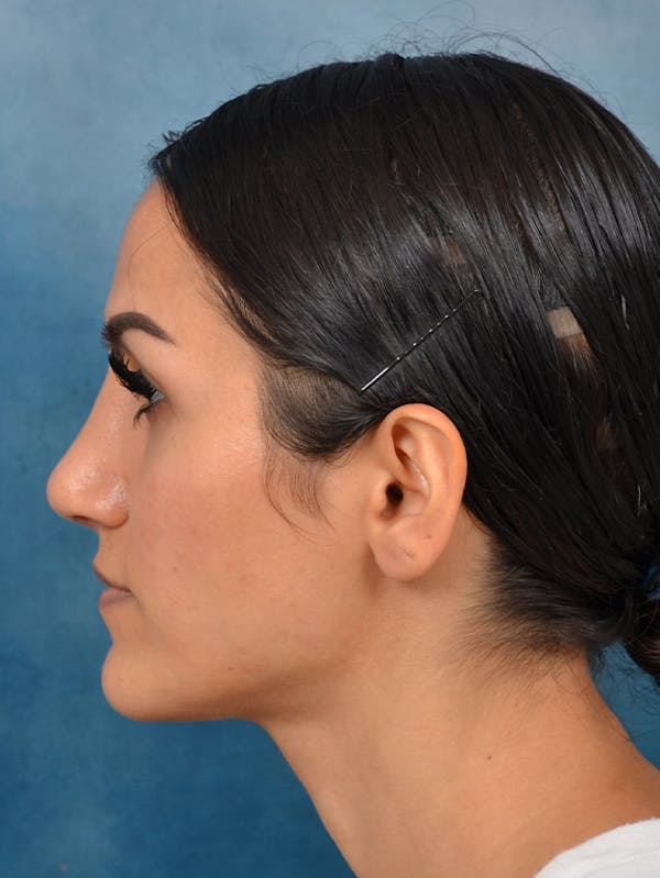 Rhinoplasty Before & After Gallery - Patient 141137449 - Image 2
