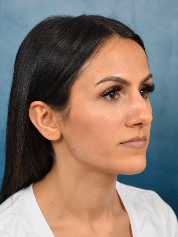 Rhinoplasty Before & After Gallery - Patient 141137449 - Image 7