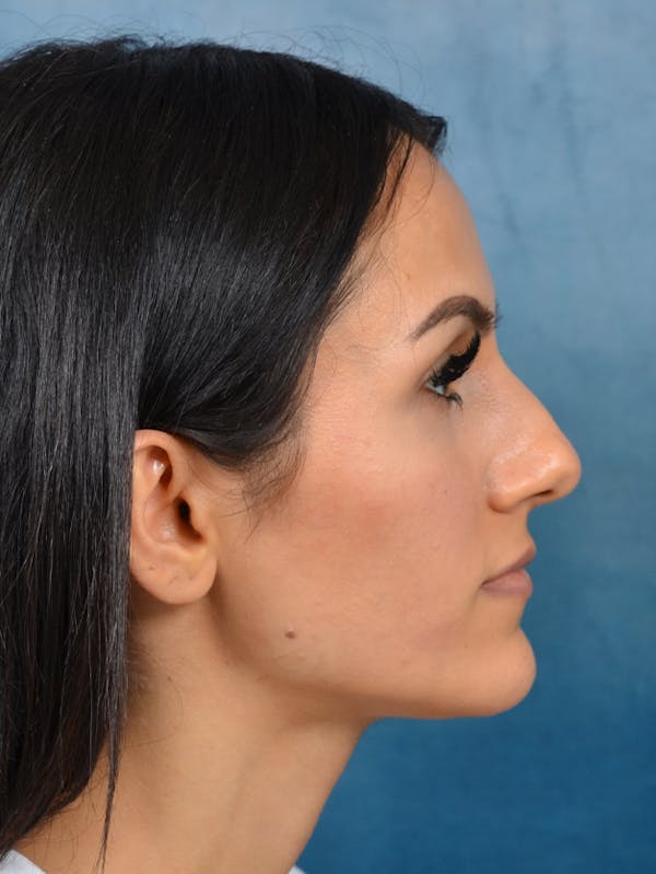 Rhinoplasty Before & After Gallery - Patient 141137449 - Image 9