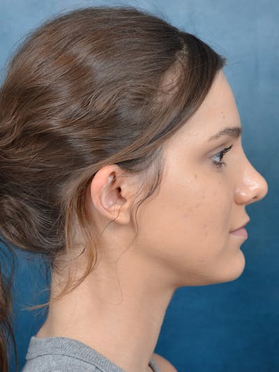 Rhinoplasty Before & After Gallery - Patient 141137829 - Image 10