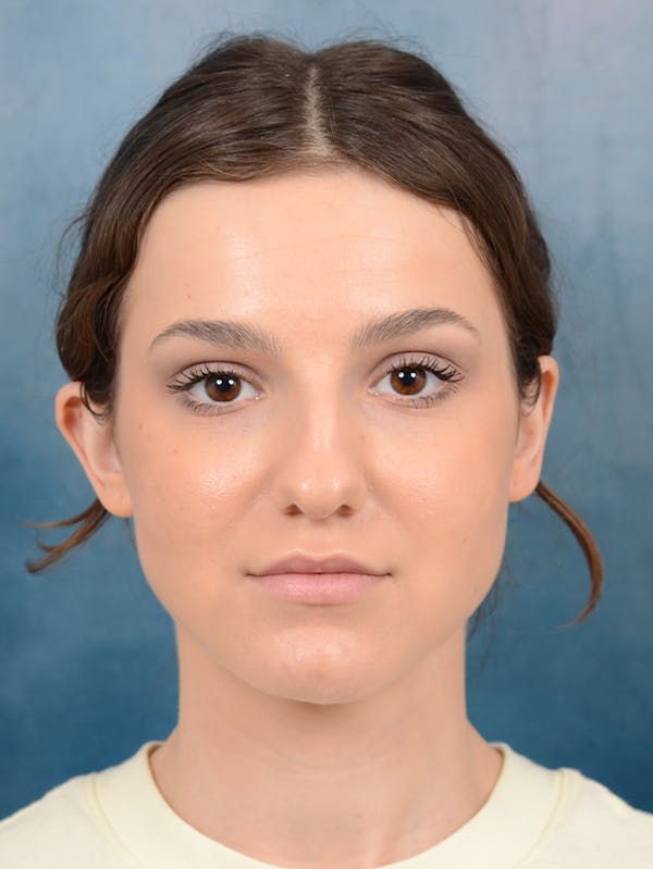 Rhinoplasty Before & After Gallery - Patient 141137829 - Image 3