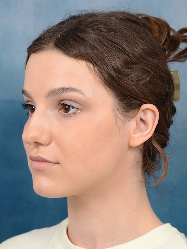 Rhinoplasty Before & After Gallery - Patient 141137829 - Image 5