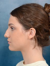 Rhinoplasty Before & After Gallery - Patient 141137829 - Image 1