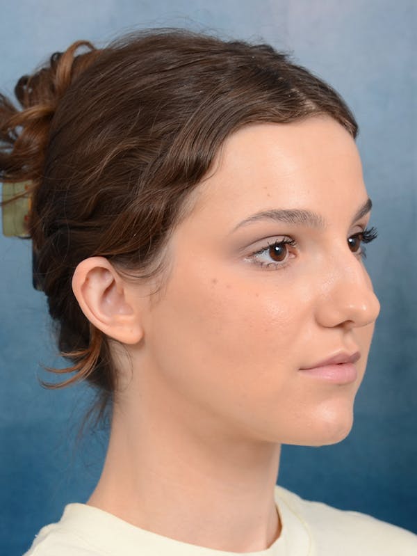 Rhinoplasty Before & After Gallery - Patient 141137829 - Image 7