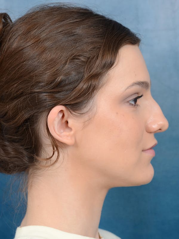 Rhinoplasty Before & After Gallery - Patient 141137829 - Image 9