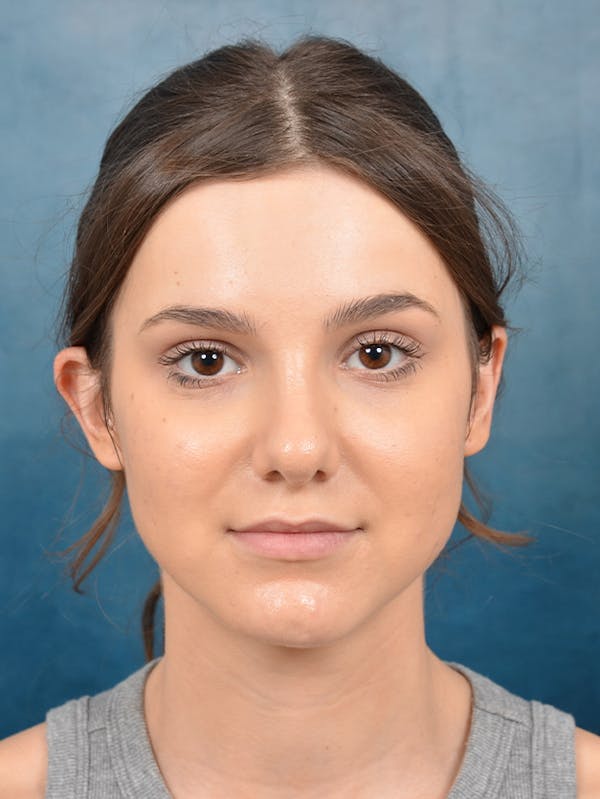 Rhinoplasty Before & After Gallery - Patient 141137829 - Image 4