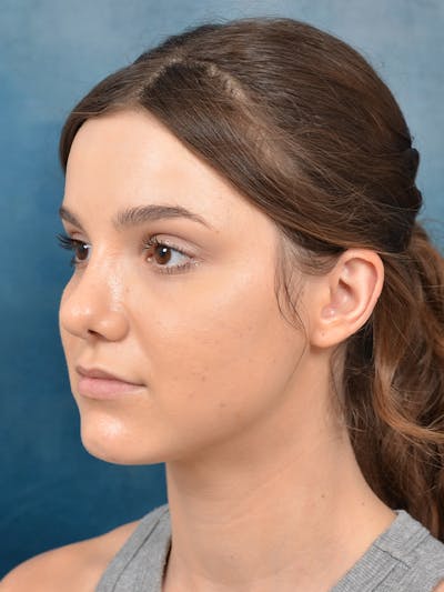 Rhinoplasty Before & After Gallery - Patient 141137829 - Image 6