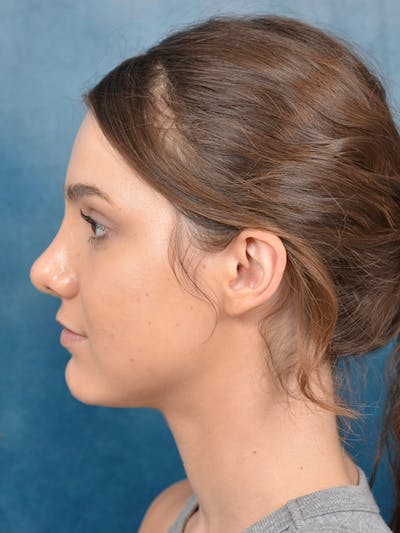 Rhinoplasty Before & After Gallery - Patient 141137829 - Image 2