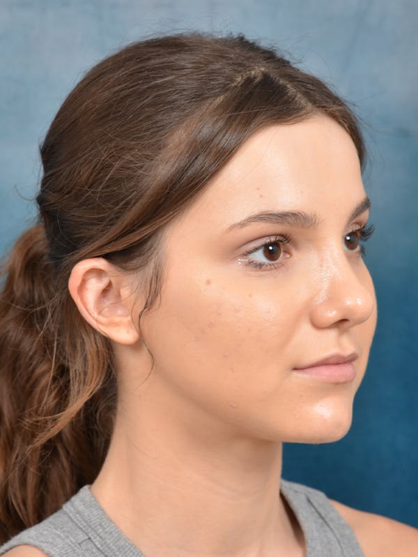 Rhinoplasty Before & After Gallery - Patient 141137829 - Image 8