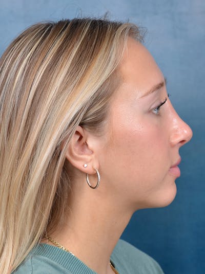 Rhinoplasty Before & After Gallery - Patient 141137861 - Image 10