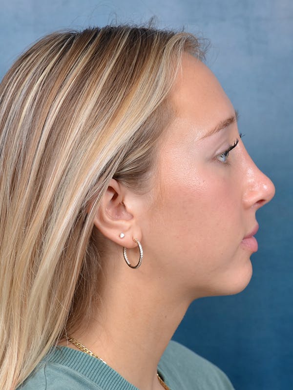 Rhinoplasty Before & After Gallery - Patient 141137861 - Image 10
