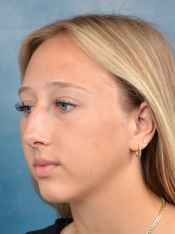 Rhinoplasty Before & After Gallery - Patient 141137861 - Image 5