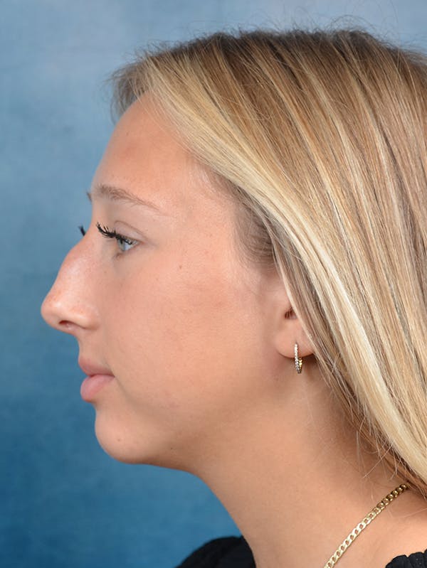 Rhinoplasty Before & After Gallery - Patient 141137861 - Image 1