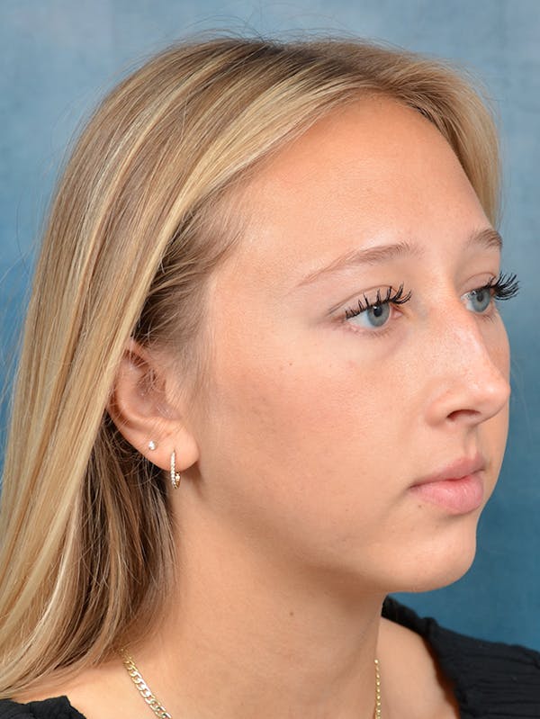 Rhinoplasty Before & After Gallery - Patient 141137861 - Image 7