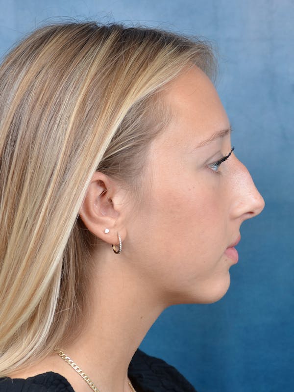 Rhinoplasty Before & After Gallery - Patient 141137861 - Image 9
