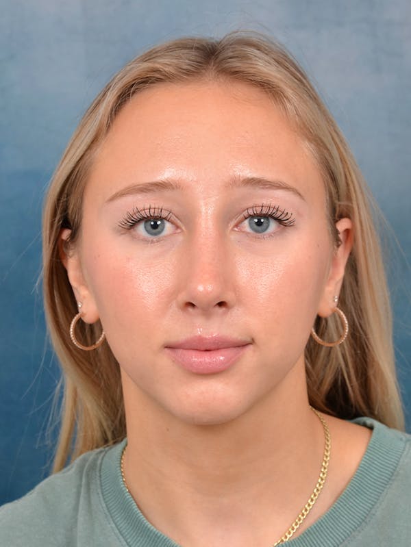 Rhinoplasty Before & After Gallery - Patient 141137861 - Image 4