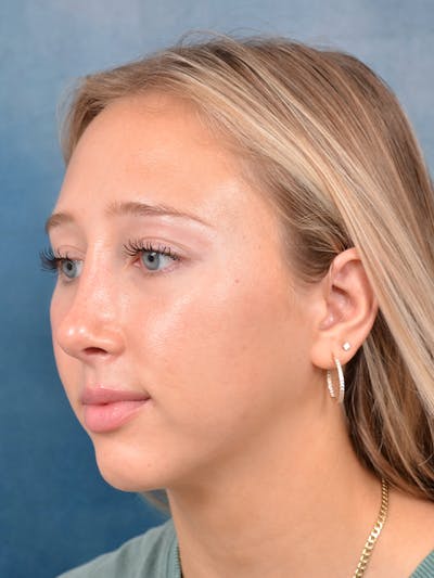 Rhinoplasty Before & After Gallery - Patient 141137861 - Image 6