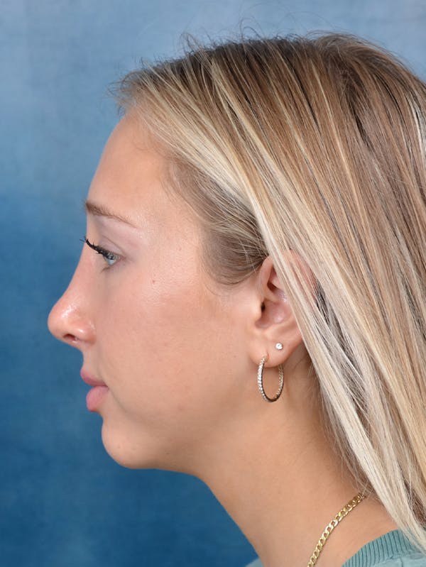 Rhinoplasty Before & After Gallery - Patient 141137861 - Image 2